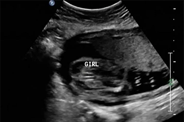 Gender Scan - After 16 Weeks